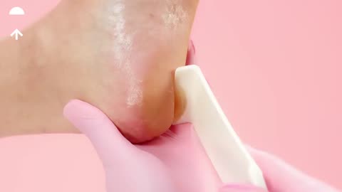 Extremely SATISFYING Calluspeeling - Foot Care