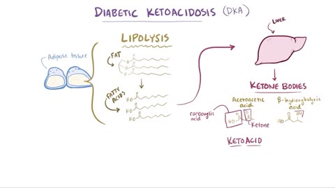 Diabetes mellitus (type 1, type 2) & diabetic ketoacidosis (DKA)