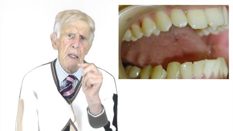 Tongue Splinting By Prof John Mew