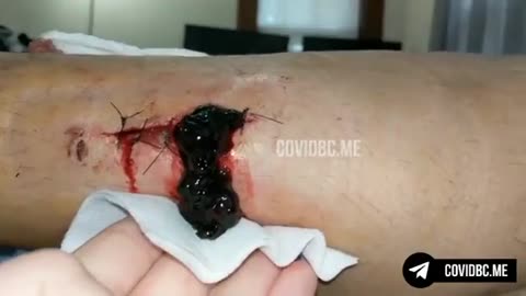 WARNING! GRAPHIC - Freshly sutured wound erupts, pours out clots