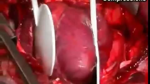 Heart CPR During Open Surgery
