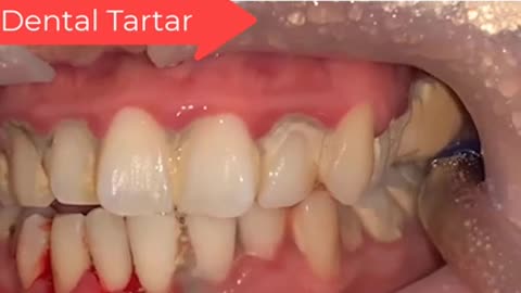 Tartar Dentist 2021 | Satisfying Dental-work