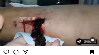 Arm blood clot from death vaccine