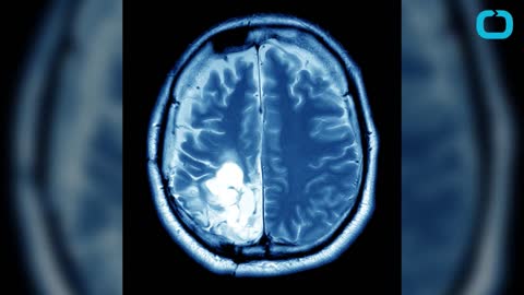 What Is A Brain Aneurysm?