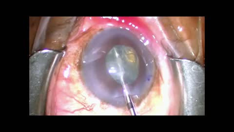 Master the miLOOP in cataract surgery