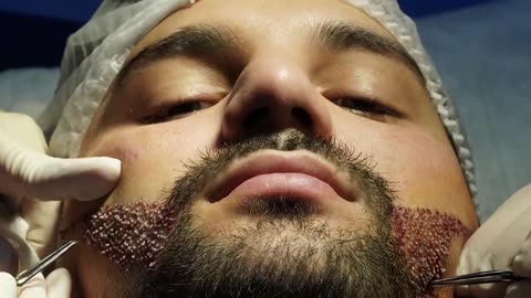 Face Surgery _Beard Transplant