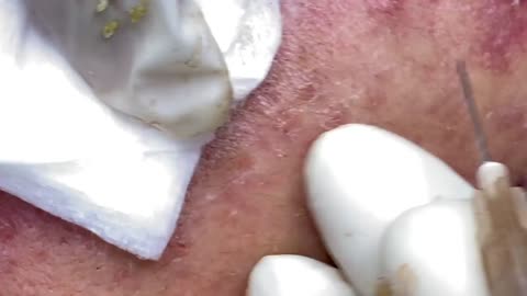 Satisfying blackhead removal