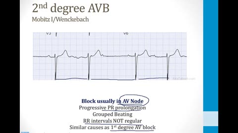 Cardiology - 4. Arrhythmias - 2.AV and Bundle Branch Blocks