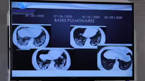 Dióxido de Cloro, el mejor tratamiento para el Covid 19