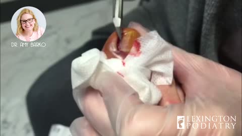 Pus ingrown nail