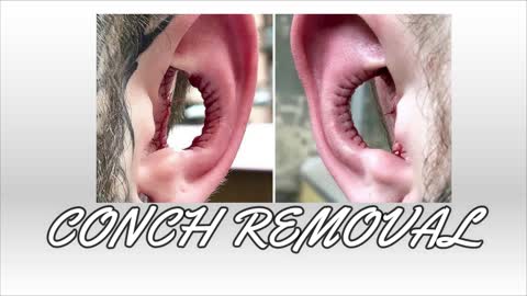 CONCH REMOVAL AND SIDE EFFECTS😱😱😱