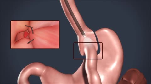 Endoscopic Stoma Revision Surgery