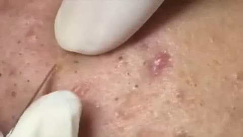 removing giant blackhead