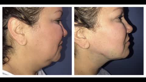 Dr. Thomas BARNES Newport Beach Neck LIPO live!!!