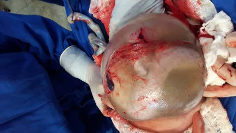 Rare Twin Birth Inside Amniotic Sac