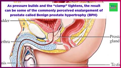 Shrink prostate Without Surgery