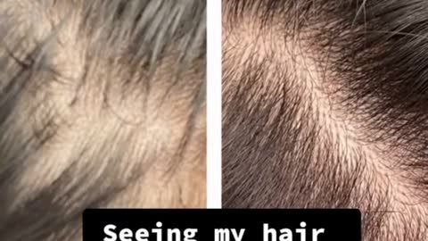 Hair Loss in women's 🤔