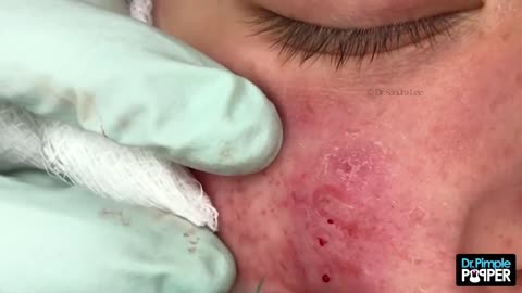 Acne & Whitehead Extractions - Session 2