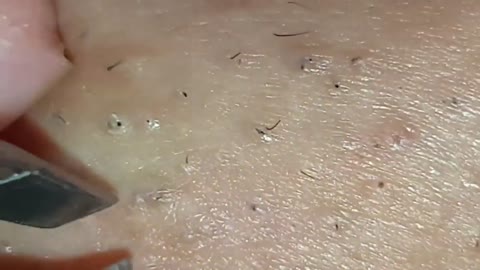 ingrown hair - ingrown hair removal - popping pimple asmr - back pimples