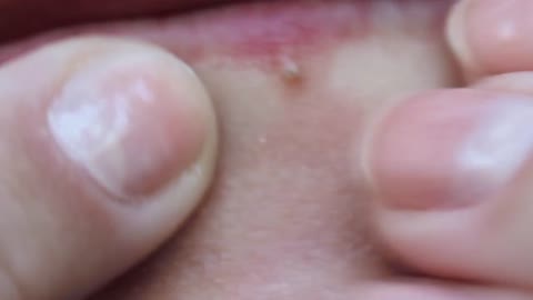 lip blackheads removal video