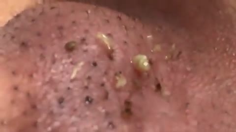 Black head removal