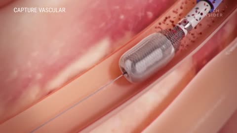 How this devise safely Removes blood clots || tech insider