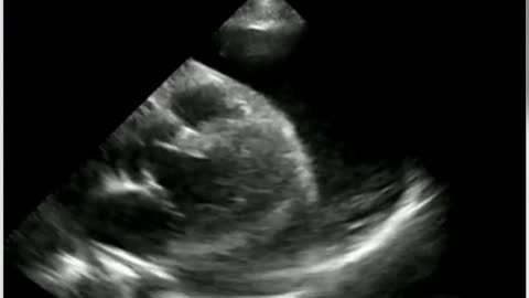 PSLX Ultrasound