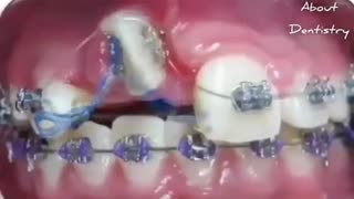 Orthodontic treatment timelapse. Insane right?