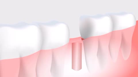 dental implantation procedure of putting teeth the artificial teeth in mouth