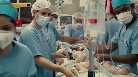 Brazilian doctors successfully separate three-year-old twins conjoined at the head after 27h surgery