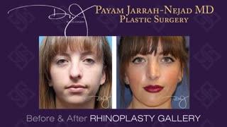 Jarrah-Nejad | Dr. J Plastic Surgery Rhinoplasty Before & Afters @ drjplasticsurgery.com