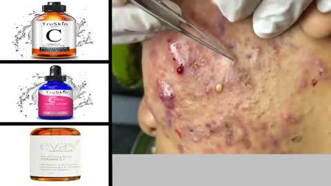 Blackhead Removal and pimple pumping