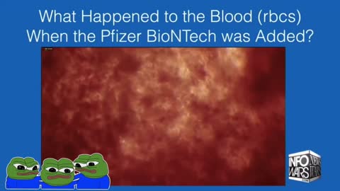 Dr. Richard Fleming: Pfizer mRNA Shot Causes Blood Clots When Looked at Through the Microscope