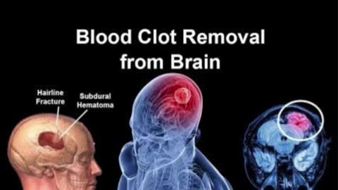 When blood clots in human brain. treatment Explain in 3D animation