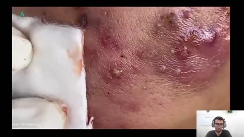 Silent Popping Pimples Reactions