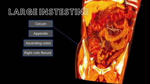 Large Intestine and Umbilical Hernias