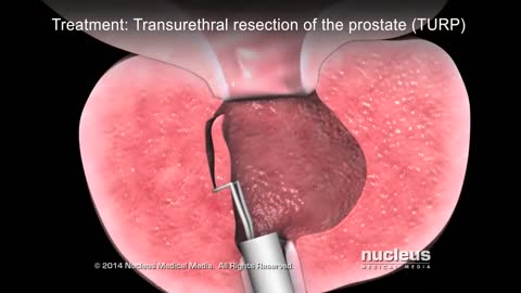 The Prostate Cancer Symptoms - BPH. and the cure.