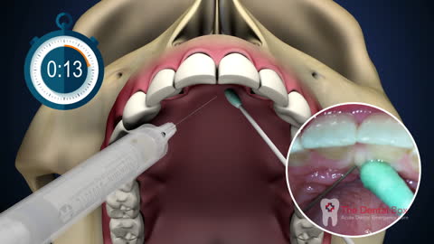 DentalBox - Nasopalatine Nerve Block