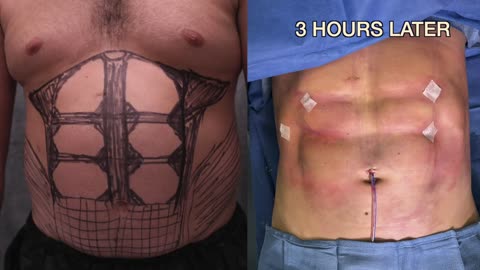 6-Pack Abs in 3 Hours | PLASTIC SURGERY PROCEDURE