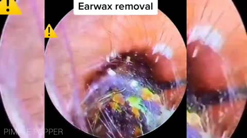 ear wax remover