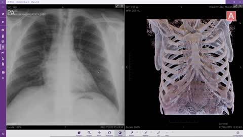 Anatomia Radiológica: COSTELAS