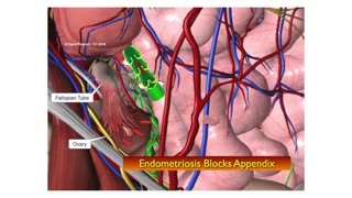 Progesterone Prescriptions: Are They Worsening Your Endometriosis Symptoms?