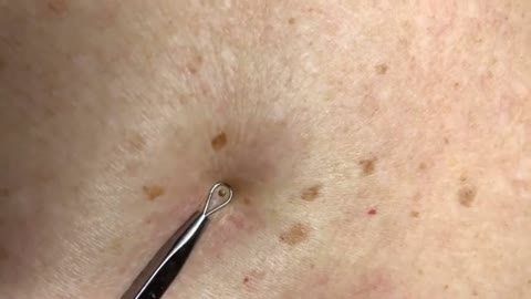 Best place for popping