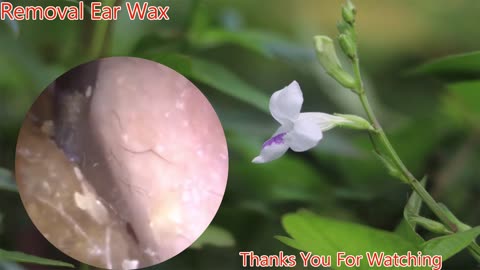 gigantic ear wax removal #14