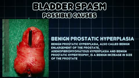 Bladder spasm Medical Symptom & Relief