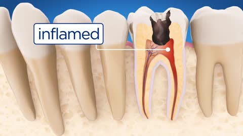 Dental Root Canal Treatment RCT