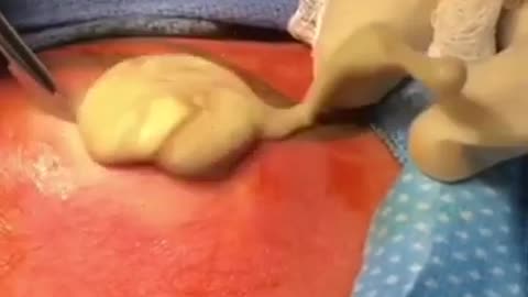 Terrifying Abscesses Incision Drainage!