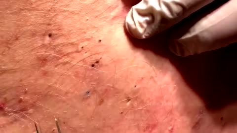 Extremely satisfying video of blacxkhead and whitehead removal 2
