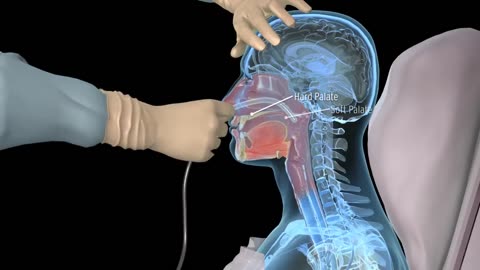 How to insert a Nasogastric tube for NG incubation