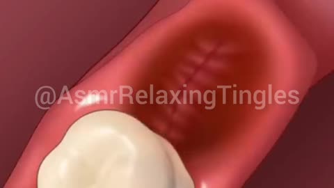 ASMR wisdom tooth cavity treatment😁Relaxing🥰